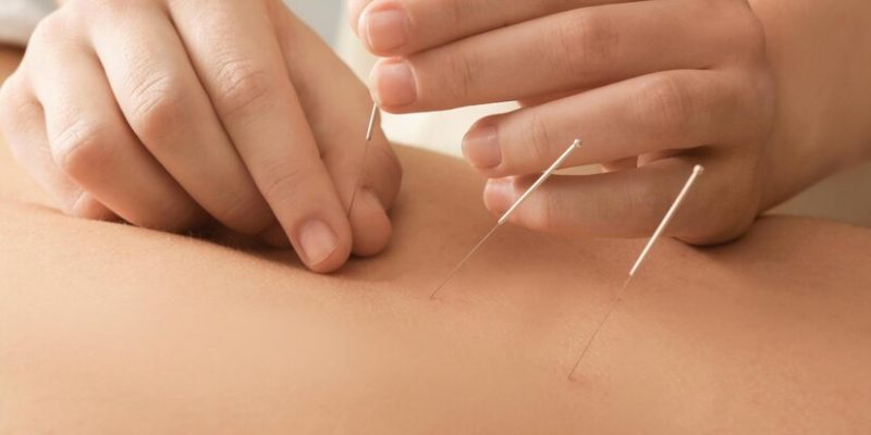 young-man-getting-acupuncture-treatment-closeup_495423-14343