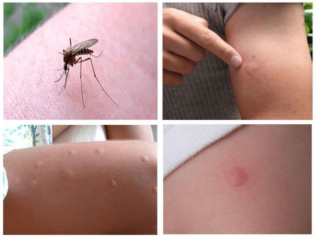 комариные укусы